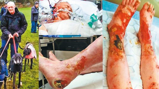 செல்லப்பிராணியால் வந்த வினை – கால்களை இழந்த நபர்