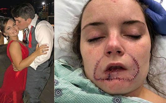 காதலியின் உதட்டை கடித்து எறிந்த காதலன் : நீதிமன்றம் விதித்த கடும் தண்டனை!!