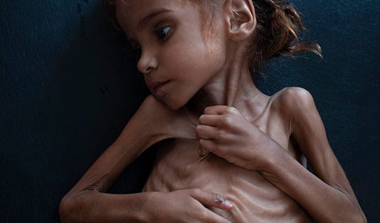 உலகையே திரும்பி பார்க்க வைத்த யேமன் சிறுமி மரணம்!!