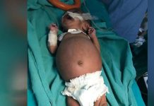 பிறந்த குழந்தையின் வயிற்றுக்குள் இருந்த இரட்டைக் குழந்தைகள் : அதிர்ச்சியடைந்த மருத்துவர்கள்!!