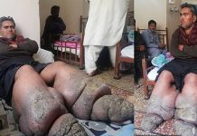 50 கிலோ அளவுக்கு வீங்கிய கால்கள் : தடைப்பட்ட மகளின் திருமணம் : போராடும் குடும்பம்!!