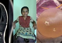 8 வயது சிறுமியின் மூளைக்குள் இருந்த உயிரினத்தின் 100க்கணக்கான முட்டைகள் : அதிர்ந்து போன மருத்துவர்கள்!!