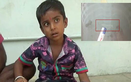 விளையாடும் போது ஆணியை விழுங்கிய 5 வயது சிறுவன் : எக்ஸ்ரே எடுத்த போது அதிர்ந்த மருத்துவர்கள்!!
