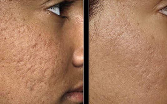 முகத்தில் உள்ள மேடு பள்ளங்களை எளிதில் மறைக்க வேண்டுமா? இதில் ஒன்றை முயற்சி செய்யுங்கள்!!