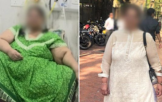 300 கிலோ எடையுள்ள பெண் அறுவை சிகிச்சைக்குப் பின் 86 கிலோவாக குறைந்த அதிசயம்!!