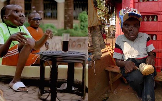 கோர முகத்தால் அவமானப்பட்ட நபர் : இன்று உலகமே பாராட்டும் பிரபலம்!!