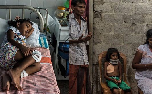 இலங்கை குண்டுவெடிப்பில் சிறுவனுக்கு பறிபோன கண்பார்வை : வலியால் துடிக்கும் சிறுமி…. மனம் வலிப்பதாக தாய் கண்ணீர்!!