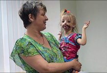 உதடுகள் இல்லாமல் பிறந்த குழந்தைக்கு!!