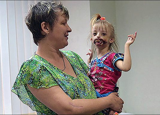 உதடுகள் இல்லாமல் பிறந்த குழந்தைக்கு!!