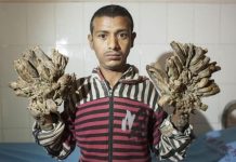 வலியால் தவித்தது போதும் : கைகள் இரண்டையும் துண்டிக்க மருத்துவரிடம் கெஞ்சிய இளைஞர்!!