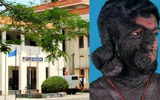 உடல் முழுவதும் மரம் போன்று இறுக்கமடையும் விசித்திர நோய்… உதவியின்றி பரிதவிக்கும் இளைஞர்!!