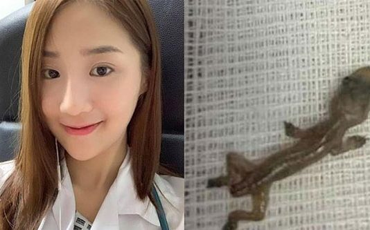 காதில் உயிருடன் இருந்த பல்லி : பெண் மருத்துவரின் வாழ்வில் மறக்க முடியாத அனுபவம் இது தானாம்!!