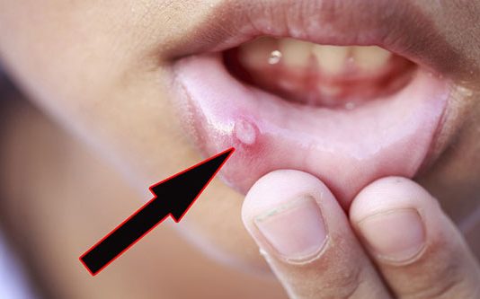 வாய்ப்புண்ணை எளிதாக குணப்படுத்த வேண்டுமா : இதோ சில அற்புத குறிப்புகள்!!