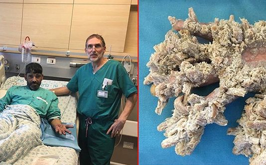 மர மனிதனை நினைவிருக்கிறதா? இப்போது அவர் எப்படி இருக்கிறார் என்று தெரியுமா?