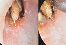 நள்ளிரவில் காது வலியால் துடித்த பெண் : மருத்துவமனையில் காத்திருந்த அதிர்ச்சி!!