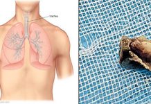 மூச்சுக்குழாயில் சிக்கியிருந்த மீனின் தலை : பரிசோதித்த மருத்துவர்களுக்கு காத்திருந்த அ திர்ச்சி!!