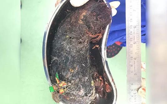 வயிற்று வ லியால் அவஸ்தையடைந்த 13 வயது சிறுமி : அறுவை சிகிச்சையில் காத்திருந்த அ திர்ச்சி!!