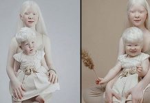 வித்தியாசமான நிறத்தில் பிறந்த குழந்தை : தாயை சந்தேகித்த மருத்துவர்கள் : அவர்களது இன்றைய நிலை!!