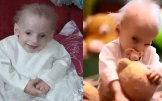 8 வயதில் 80 வயதுக்கான முதுமையுடன் இருந்த அபூர்வ சிறுமிக்கு நேர்ந்த கதி!!