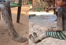 கல்லாக மாறும் உடல் : நரக வே தனை : அபூர்வ வியாதியுடன் போ ராடும் சிறுமி!!