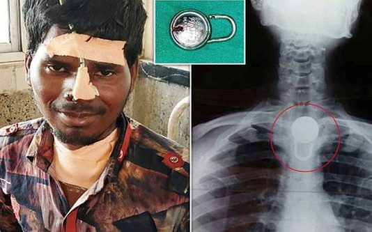 மூச்சு திணறலால் மருத்துவமனையில் அனுமதிக்கப்பட்ட இளைஞன் : ஸ்கேன் ரிப்போர்ட்டில் மருத்துவர்கள் கண்ட காட்சி!!