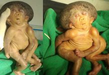 ஒற்றை த லையுடன் பா ம்பு போல பின்னிப் பி ணை ந்து பிறந்த இ ரட்டை கு ழந் தைகள்! க டு ம் அ தி ர்ச் சியில் உறைந்த ம ரு த்துவர்கள்!!