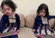 ஒட்டிப்பிறந்த இரட்டையர்கள் மருத்துவர்களின் கடும் போராட்டத்திற்கு பின்னர் பிரிக்கப்பட்டனர்!