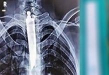 சாப்பிட மு.டியாமல் தி.ண.றி வந்த நபர்..! – ஸ்கேன் ரி.ப்போ.ர்ட்டை பார்த்து ஆ.டி.ப்.போ.ன மருத்துவர்கள்..!