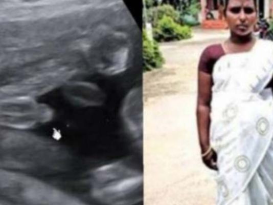 வயிற்றில் குழந்தை என 7 மாதமாக சிகிச்சையளித்த மருத்துவர்.. திடீரென ஏற்பட்ட வலி! ஸ்கேனில் தெரியவந்த அ.திர்ச்சி உண்மை!!