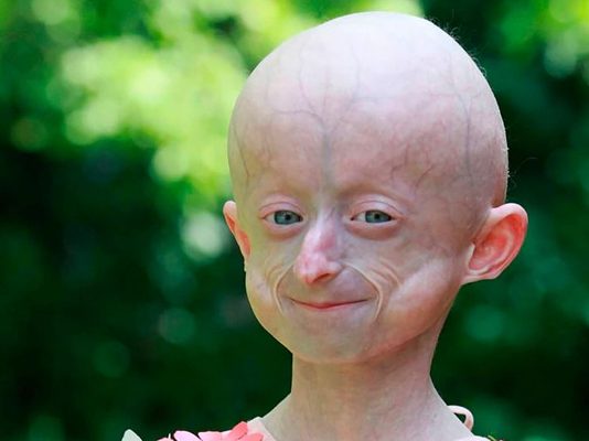 80 வயது தோற்றம்… அரியவகை நோய்: 10 வயதில் ப.ரி.தாப ம.ர.ணம்!!