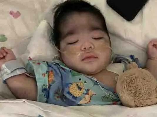 உடல் முழுவதும் முடி வளர்ந்து கொரில்லா போன்று மாறிவரும் கு.ழ.ந்தை: காரணம் என்ன?