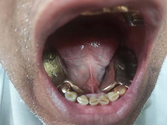 வாயில் ஒரு கிலோ தங்கம்: அதிர வைத்த பலே க.ட.த்தலால் ஆடிப்போன அதிகாரிகள்!!