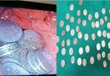 வயிற்று வலி வாலிபருக்கு அறுவை சிகிச்சை செய்த போது டாக்டர்களுக்கு காத்திருந்த அதிர்ச்சி!!